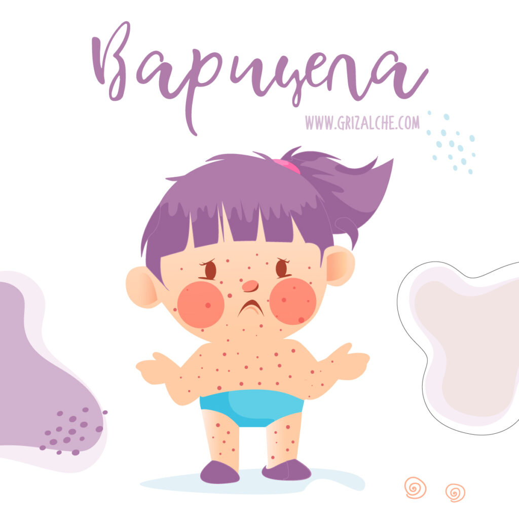 Всичко за варицелата, шарка, лещенка