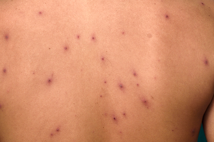 варицела дете коричка круста